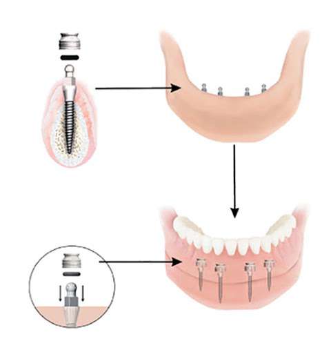 Mini Dental Implant Solutions Homewood, IL